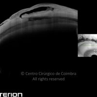 Trabeculectomia tipo Cairns Trabeculectomia tipo Cairns