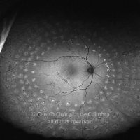 Fotocoagulação Panretiniana, autofluorescência Fotocoagulação Panretiniana, autofluorescência