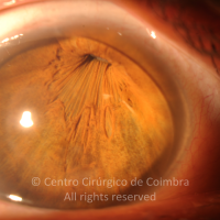 Iris Retraction (post-surgical).
