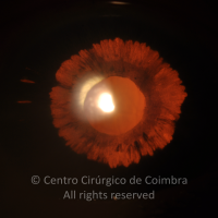 Intraocular lens-induced iris trauma, with loss of pigment. Aphakia.