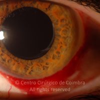 Hemorragia Subconjuntival Hemorragia Subconjuntival